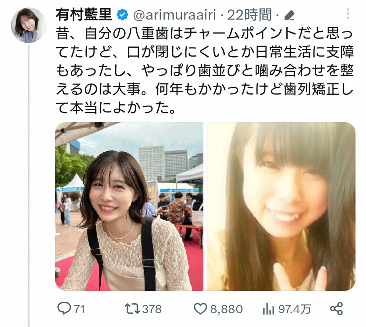【画像・写真】有村藍里「歯列矯正して本当によかった」と思いつづる　整形前の“垢抜け意識”姿も